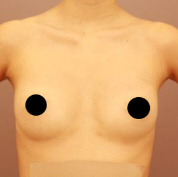 授乳後のコンデンスリッチ豊胸＋乳頭縮小【術前／3ヶ月  28歳女性】の術後写真