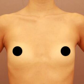 授乳後のコンデンスリッチ豊胸＋乳頭縮小【術前／3ヶ月  28歳女性】の術前写真