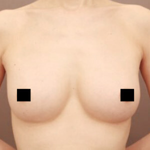 コンデンスリッチ豊胸【術前／6ヶ月 44歳】の術後写真