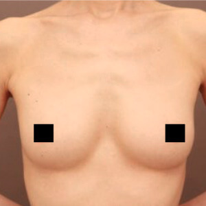 コンデンスリッチ豊胸【術前／6ヶ月 44歳】の術前写真