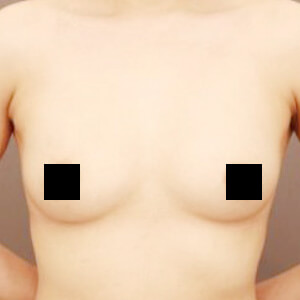 コンデンスリッチ豊胸【術前／6ヶ月 35歳】の術後写真