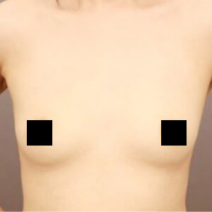 コンデンスリッチ豊胸【術前／6ヶ月 35歳】の術前写真