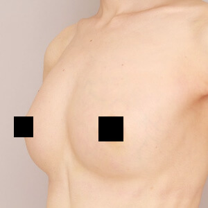 授乳後のコンデンスリッチ豊胸【術前／1ヶ月 40歳】の術後写真