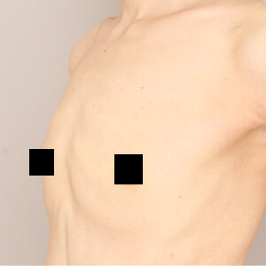 授乳後のコンデンスリッチ豊胸【術前／1ヶ月 40歳】の術前写真