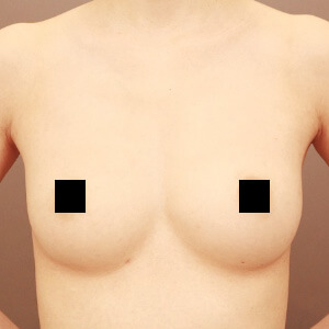 痩せ方のコンデンスリッチ豊胸【術前／6ヶ月 32歳 (BMI:18)】の術後写真