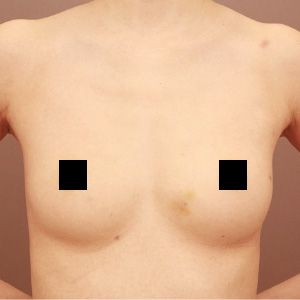 痩せ方のコンデンスリッチ豊胸【術前／6ヶ月 32歳 (BMI:18)】の術前写真