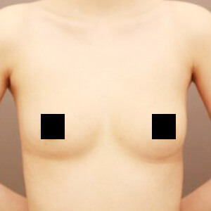 シリコンバッグ抜去後のコンデンスリッチ豊胸【術前／6ヶ月 23歳】の術後写真