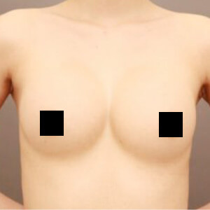 シリコンバッグ抜去後のコンデンスリッチ豊胸【術前／6ヶ月 23歳】の術前写真