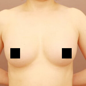 2回目のコンデンスリッチ豊胸【術前／6ヶ月 41歳】の術後写真