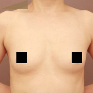 2回目のコンデンスリッチ豊胸【術前／6ヶ月 41歳】の術前写真