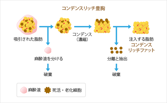コンデンスリッチ豊胸