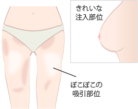 脂肪採取のよくある失敗