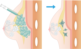 塊で注入された場合