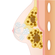 不純物によるしこり