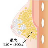 約250ccまでがしこりにならない量の目安