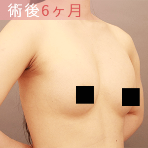 元のサイズが小さい方の症例、術後6か月