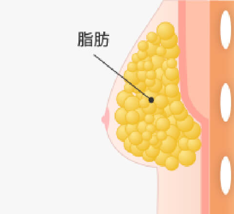 偽性女性化乳房