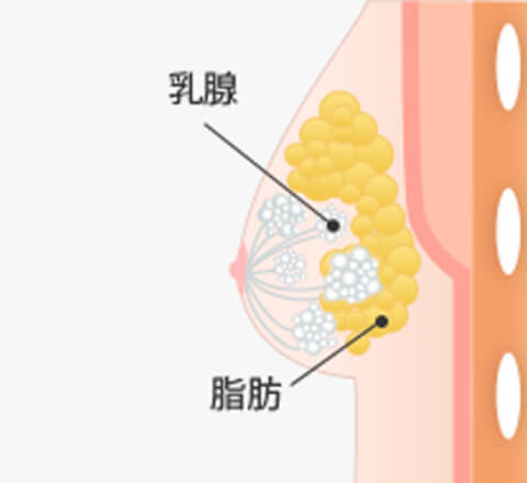 混合性女性化乳房
