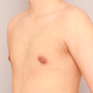 女性化乳房 Mods Clinic モッズクリニック 公式 東京 銀座 大阪 女性化乳房 Mods Clinic モッズクリニック 公式 東京 銀座 大阪