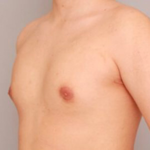 偽性女性化乳房術前／術後1ヶ月 23歳男性の術前写真