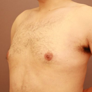 偽性女性化乳房術前／術後6ヶ月 28歳男性の術後写真