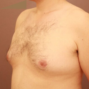 偽性女性化乳房術前／術後6ヶ月 28歳男性の術前写真