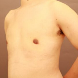 混合性女性化乳房術前／術後1ヶ月 30歳男性の術後写真