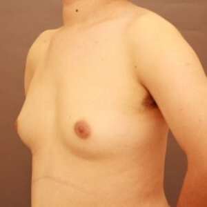 混合性女性化乳房術前／術後1ヶ月 30歳男性の術前写真