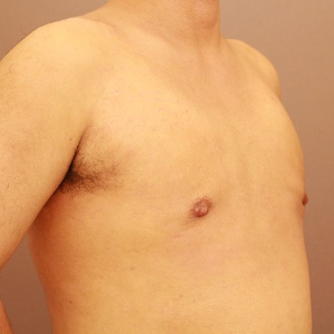 混合性女性化乳房術前／術後3ヶ月 26歳男性の術後写真
