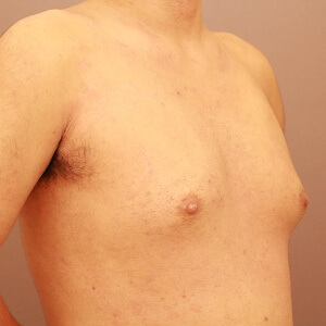 混合性女性化乳房術前／術後3ヶ月 26歳男性の術前写真