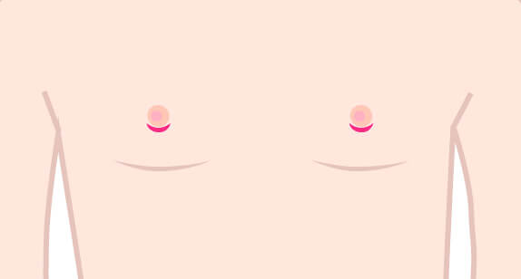 真性女性化乳房の切開の図説