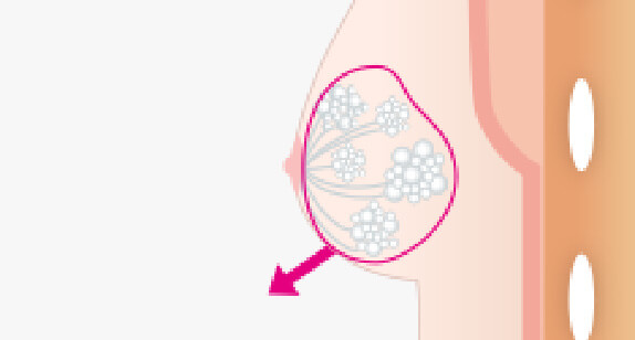真性女性化乳房の摘出の図説