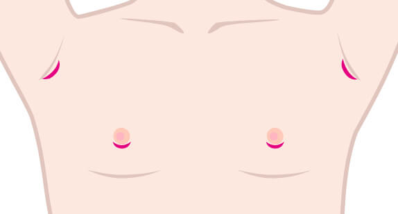 偽性女性化乳房の切開の図説