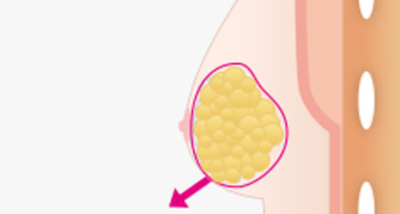 偽性女性化乳房の摘出の図説