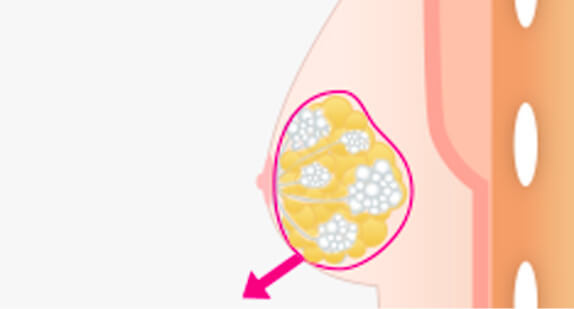 混合性女性化乳房の摘出の図説
