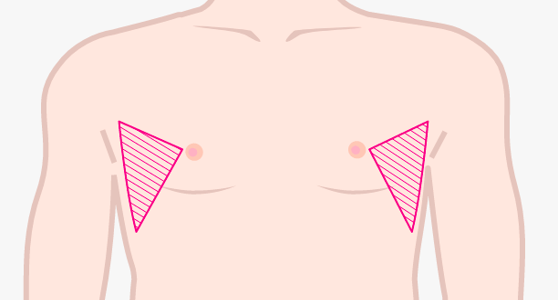 膨らみの改善だけでなく、男性らしい胸を作る