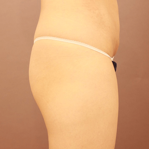 お尻の脂肪注入【術前／1ヶ月後 36歳女性】の術前写真