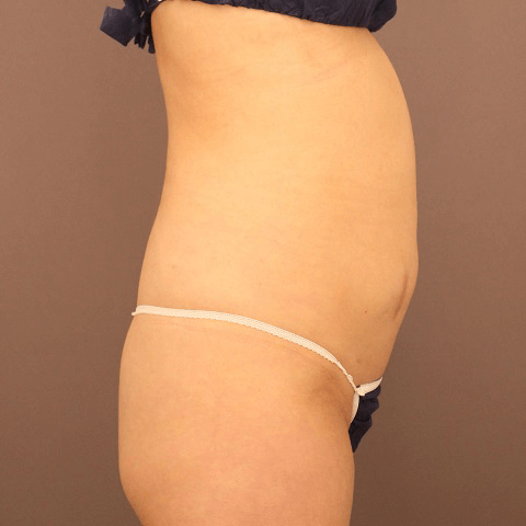 お尻の脂肪注入【術前／1ヶ月後 50歳女性】の術後写真