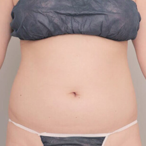 お腹・腰の脂肪吸引【術前/3ヶ月 34歳女性】の術前写真