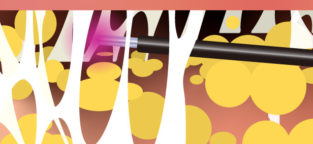 1）皮下にプローブを挿入