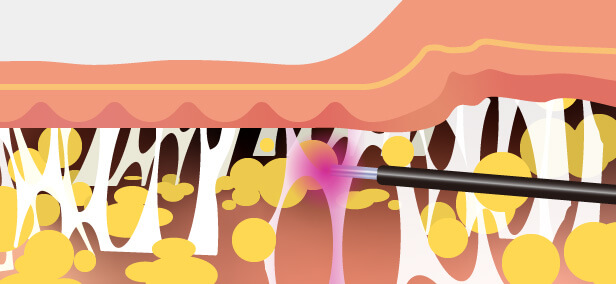2）すばやく加熱