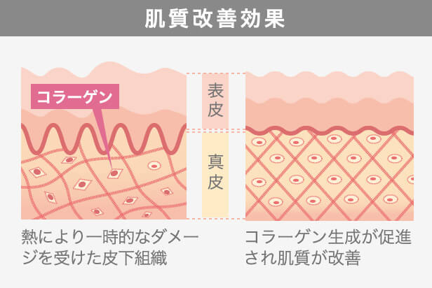 たるみだけでなく肌質までも改善
