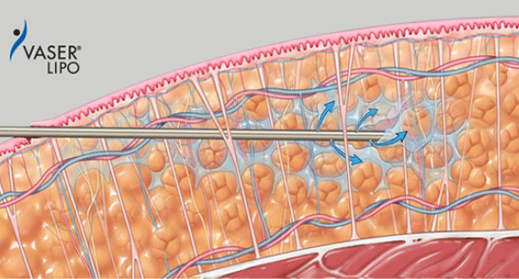 １）皮下脂肪層に麻酔液を注入