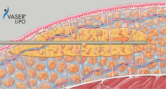 ２）ベイザー波で脂肪細胞を遊離