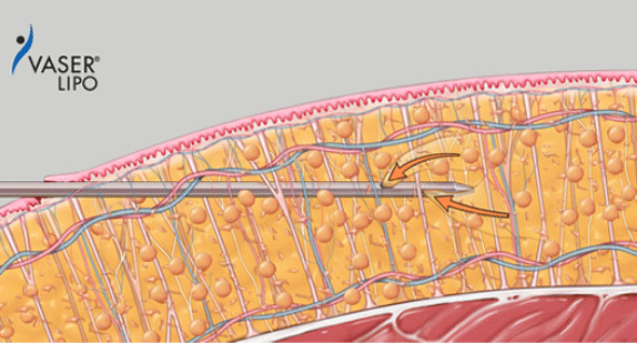 ２）ベイザー波で脂肪細胞を遊離
