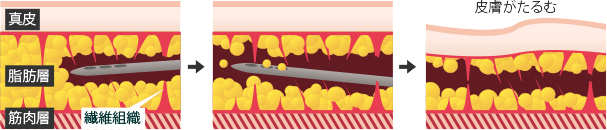 従来の脂肪吸引のイメージ