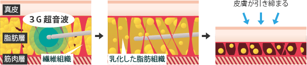 ベイザーリポのイメージ