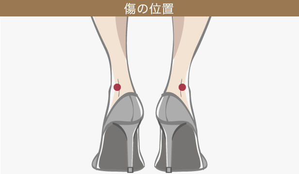 足首の脂肪吸引の傷跡