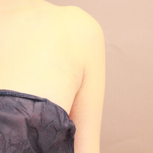 脇肉の脂肪吸引【術前／3ヶ月 28歳女性】