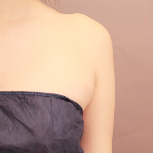 脇肉の脂肪吸引【術前／3ヶ月 28歳女性】